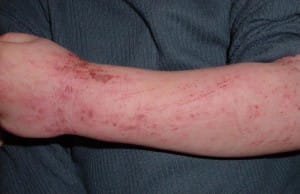 Atopijski dermatitis – kako pomagati otroku