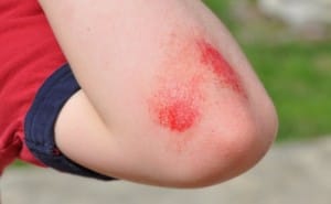 Ureznine, odrgnine in podplutbe: kako jih lahko starši oskrbimo?