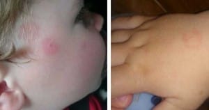 Borelioza ali lymska bolezen – nevarnost preži tudi na otroke