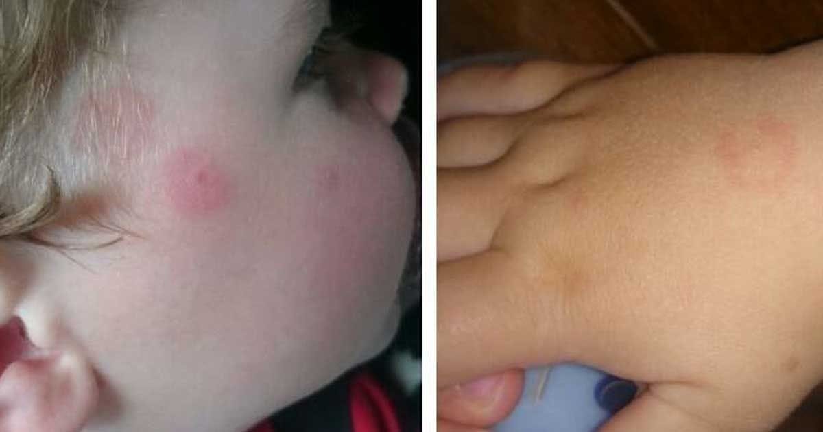 Borelioza ali lymska bolezen – nevarnost preži tudi na otroke