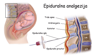 Uporaba epiduralne analgezije med porodom – koristi in nevarnosti