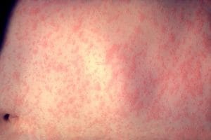 Rdečke pri otrocih – vzroki, simptomi in zdravljenje