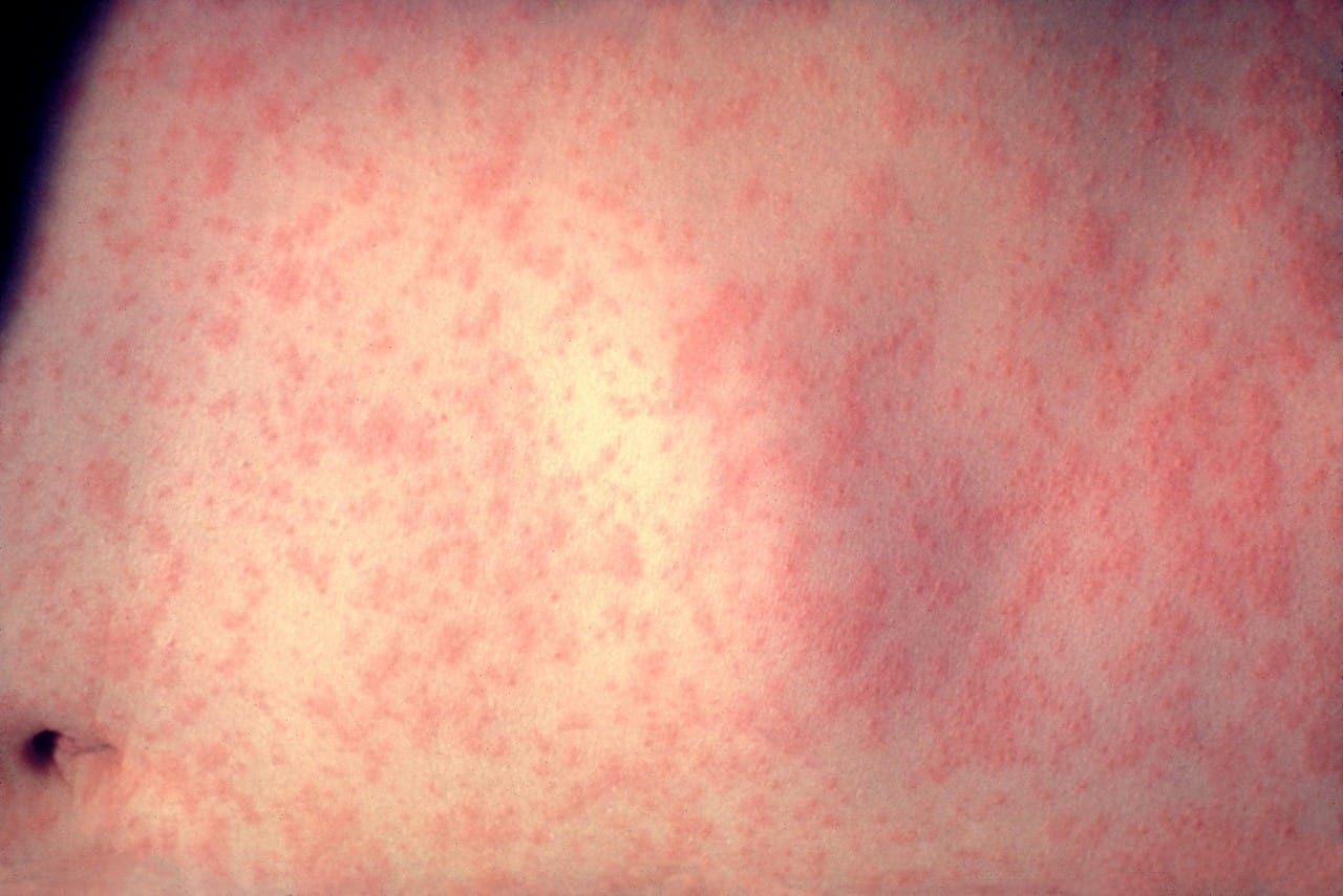 Rdečke pri otrocih - vzroki, simptomi in zdravljenje