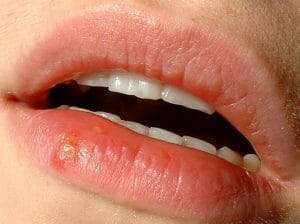 Herpes na ustnicah – simptomi in zdravljenje