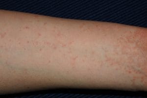 Garje: Simptomi, vzroki in zdravljenje